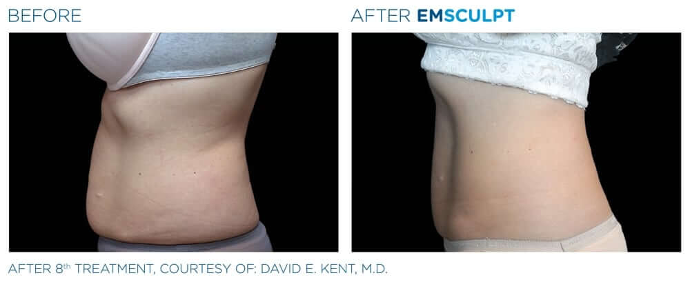 EMS Body Sculpting: Non-Invasive Body Contouring – SepiSpa