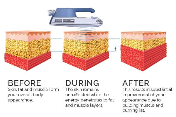 BUILD MUSCLE + LOSE FAT WHILE DOING NOTHING? EMS SCIENCE EXPLAINED! 