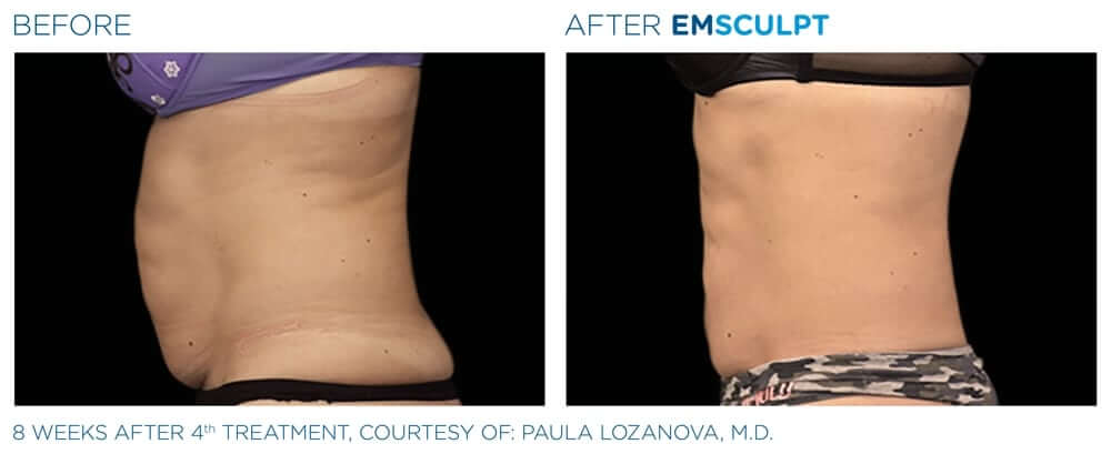 EMSculpt Non-Invasive Fat Reduction