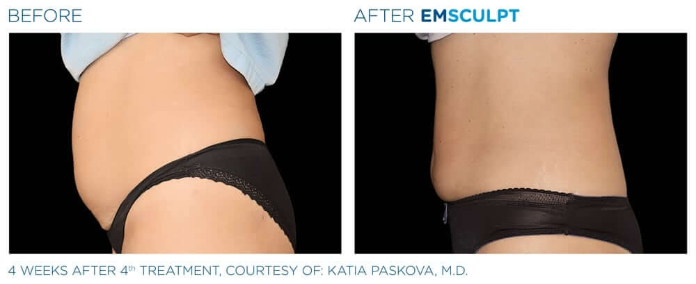 Emsculpture - How It Works & Why It's The Best Slim Toned Procedure In The  Philippines! - Beauty Affair Hub