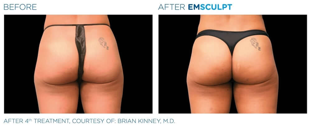 emsculpt l Non-Invasive Body Contouring and Sculpting