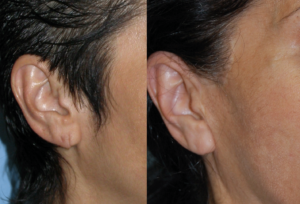 Earlobe Repair  Cosmetic Surgeon NYC